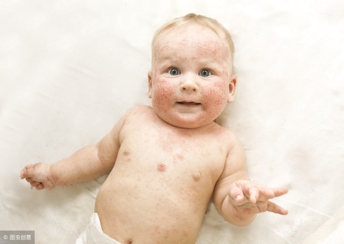 婴儿湿疹-常见皮肤病-医学