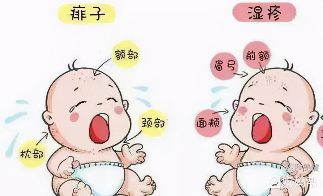 宝宝湿疹反反复复？宝妈们别紧张，儿科医生3招搞定