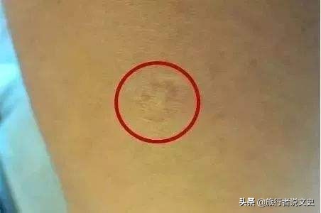 天花病毒是如何被人类彻底消灭的