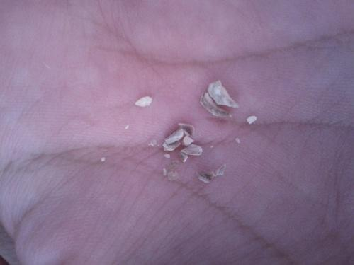 自己在家抠出牙结石,会影响牙齿吗?医院洗牙是浪费钱?