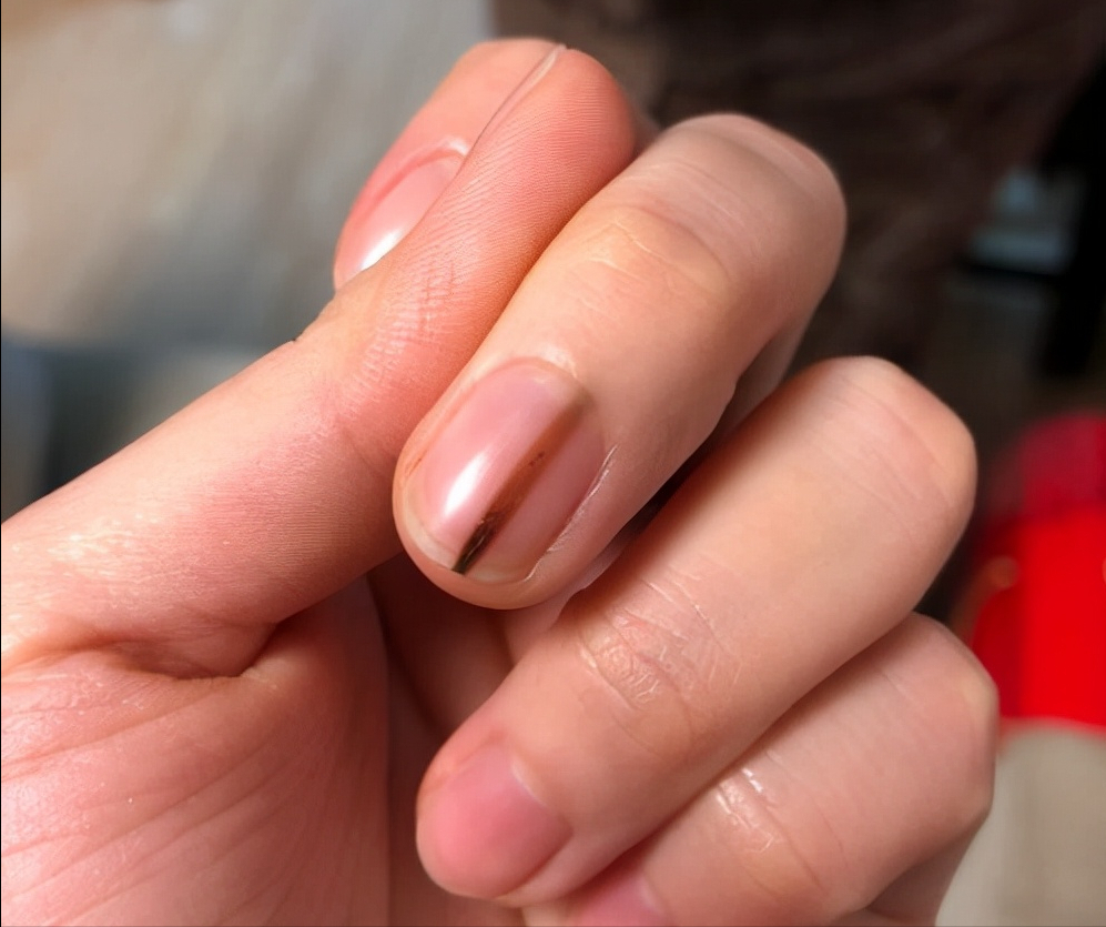 体内有病，手指先知？再次提醒：手指出现4种特征，小心疾病来袭