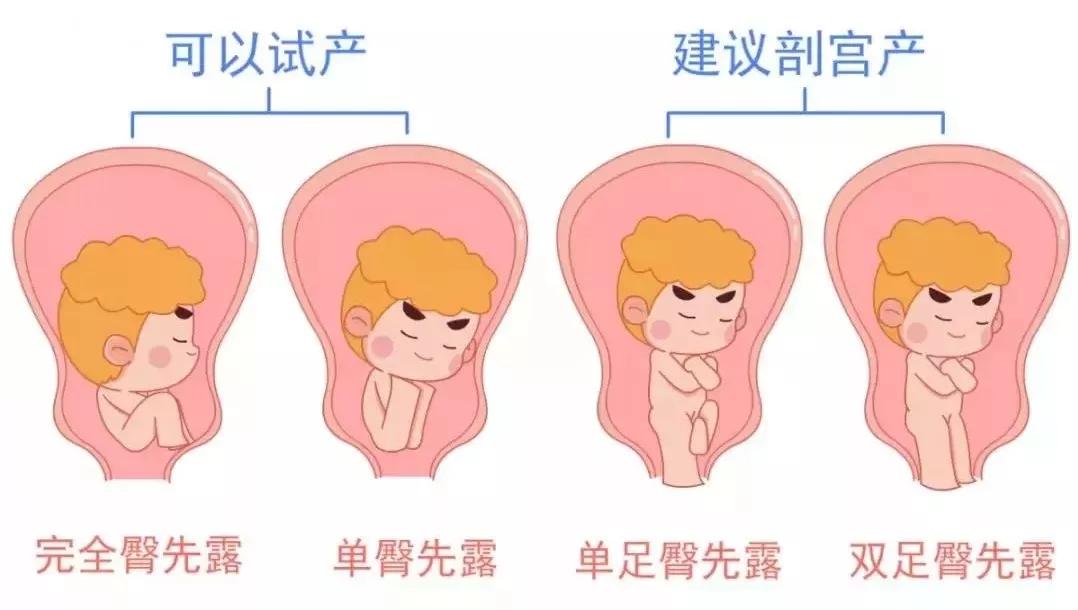 就也有可能顺利娩出所以,如果是单臀先露或者是完全臀先露的情况是