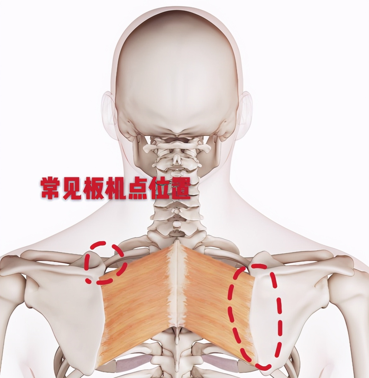 背部筋膜炎位置示意图图片