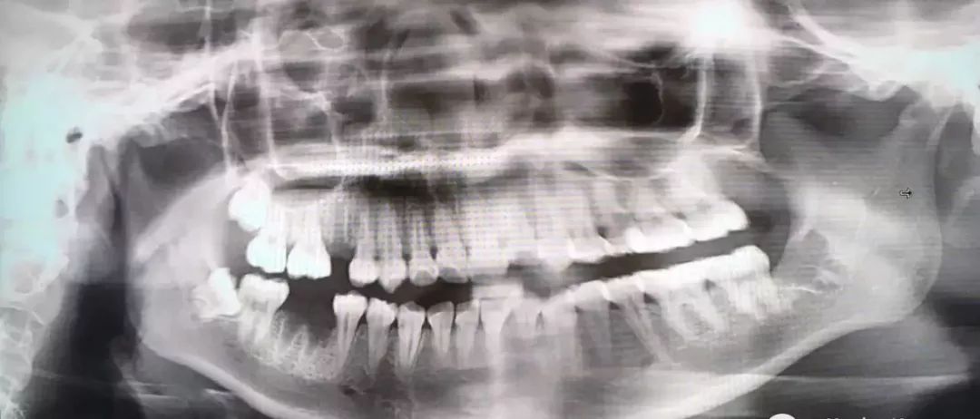 拔两颗牙收费超两万？你所不知道的智齿收费