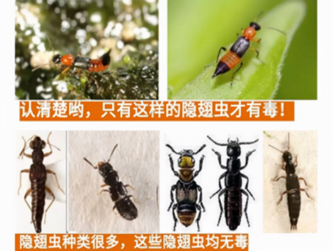 被隐翅虫咬伤急救指南,毒液酸性或可堪比硫酸?