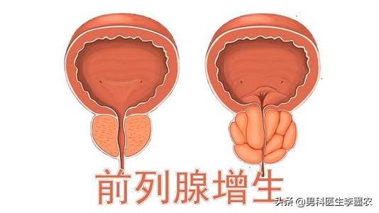 男性健康——前列腺肥大的自我检测