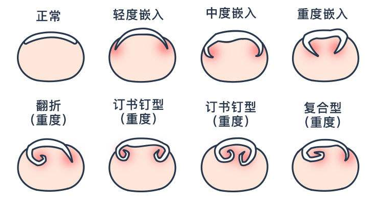 脚趾甲总往肉里长，得了“嵌甲”怎么办？医生：2个方法很管用