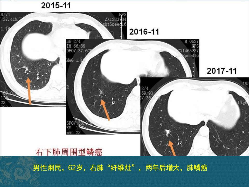 辟谣:ct报告中的"肺结节","占位"都是肺癌?
