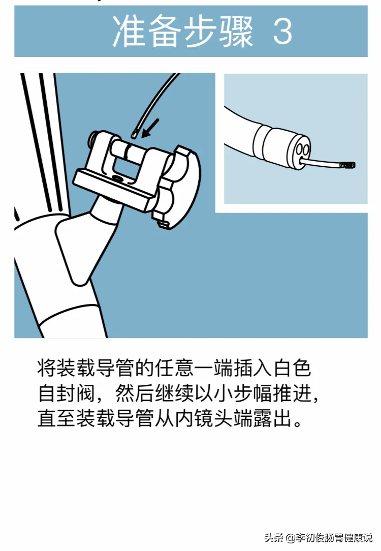 一次肠镜操作,一举三得同时完成肠道检查、套扎止血、消除内痔!