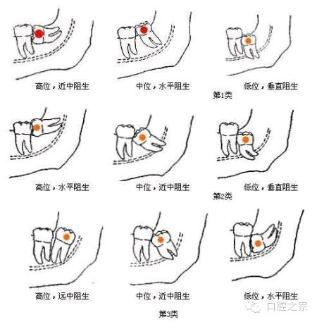 智齿到底有没有必要拔，知道这3点能帮你省不少钱