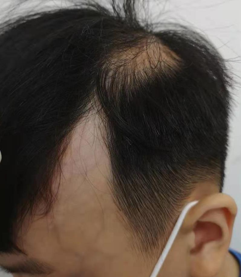如何早期识别局限性硬皮病?一文说清(内附图片)
