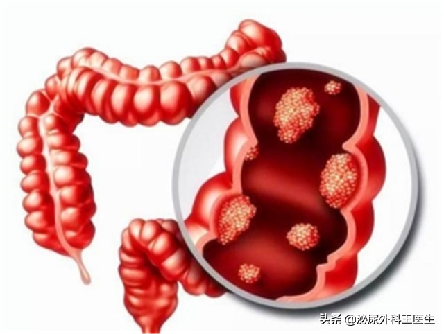 肛门摸到了小肉球，是痔疮还是尖锐湿疣？医生教你从外表就能区分