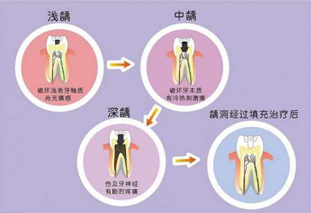 牙齿出现‘黑线’有的还被蛀空了，但却不疼，不管会影响健康吗？