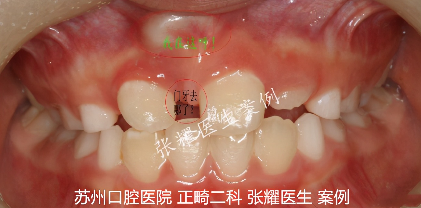 为什么90%的儿童口腔问题，源于啃手指、吐舌头、嘴呼吸等习惯？