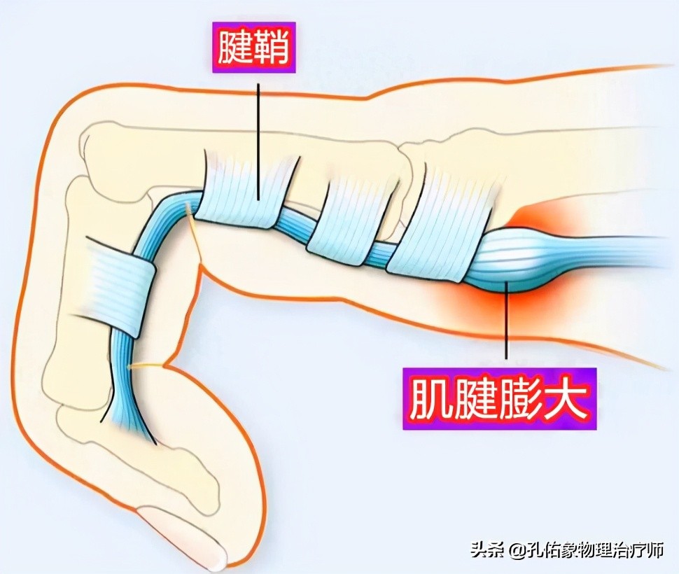 中老年女性常手指疼痛、肿胀，是腱鞘炎吗？该怎么办？告知您