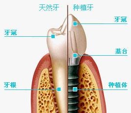 种植牙价格三千到一两万都有，中间的钱都被谁坑了？