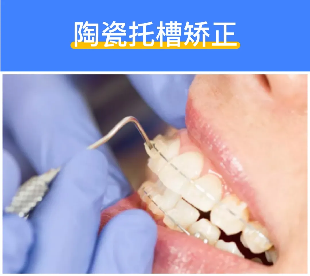 深度揭秘：牙齿矫正到底需要多少钱？