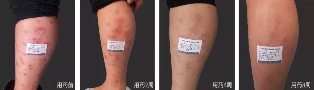 银屑病重磅新药欣比克，使用后的效果究竟怎么样？临床数据告诉你