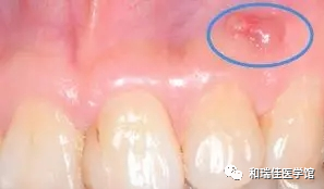 牙龈上长脓包，挤掉后还反复长出，怎么回事？