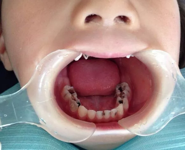乳牙坏了不用管？12岁姑娘最终花16万来切除下颌骨！#雅悦齿科#