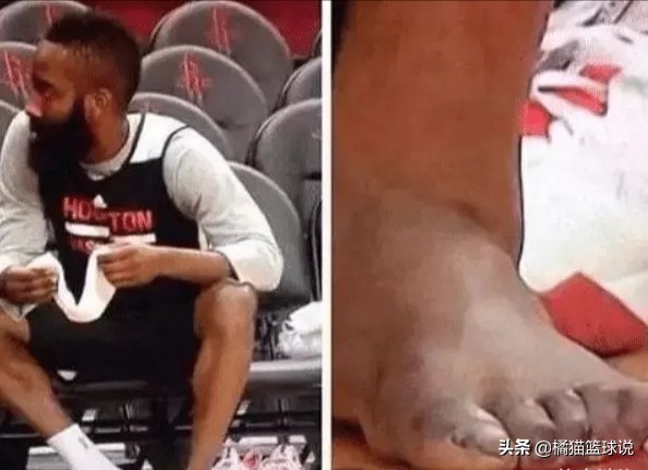 nba球星的脚为什么都畸形(做巨星的代价！哈登脚趾为何严重变形？停赛期仍疯狂训练拒绝休息)