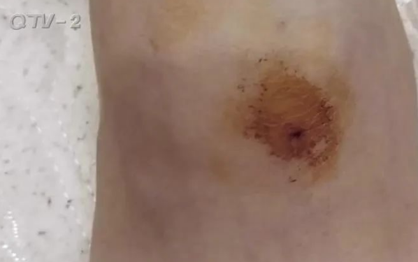 8岁女孩被同班男同学铅笔戳脚背，险些致残！学生家长透露更多恐怖细节