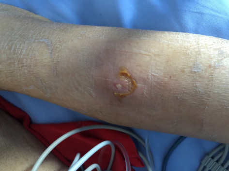 静脉输血后四级静脉炎，氧疗+水胶体贴敷轻松搞定