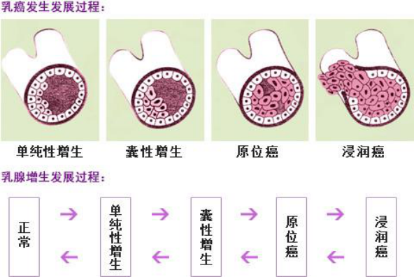 得了乳腺结节怎么办？会恶变吗？需要做手术切除吗？