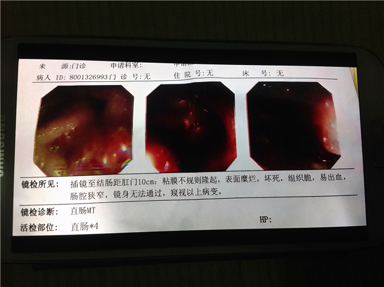 肛门癌来临前,会先经历5个症状!若发现1个,建议及早就医检查