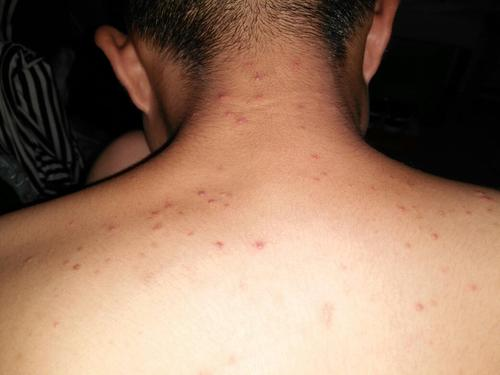 什么是螨虫型痘痘图片(后背总长痘) - 赤虎壹号