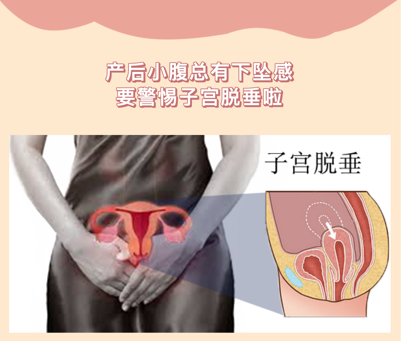 产后小腹总有下坠感，要警惕子宫脱垂啦