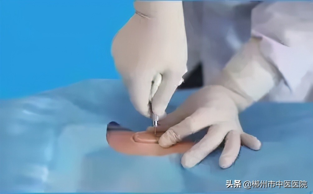 骨穿其实是一个很小的操作,一般情况下会选取富含骨髓丰富的髂后上脊