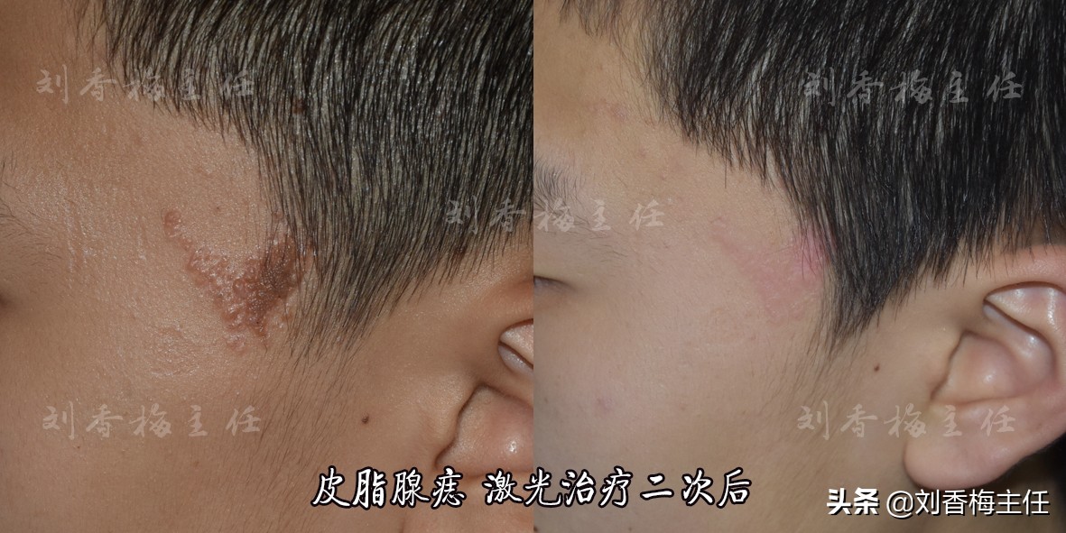 痣有很多种，有一种叫皮脂腺痣，您听说过吗？如何辨别怎么治疗？