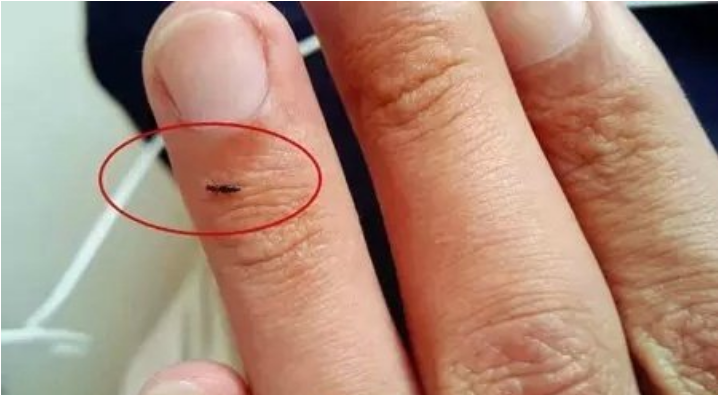 蜱虫图片咬人后图片(这两种夏季常见小虫很危险) - 赤虎壹号