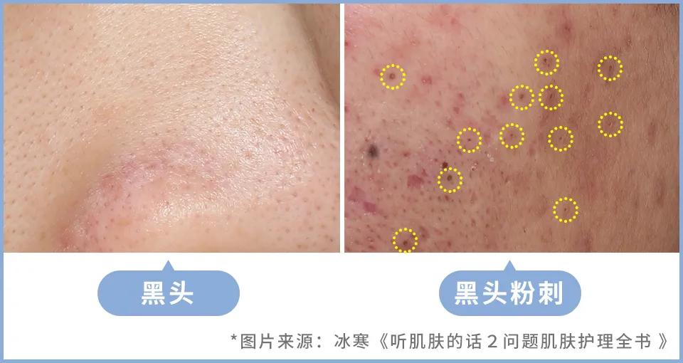 黑头究竟要怎么去？我们拔出并放大了四种类型的黑头