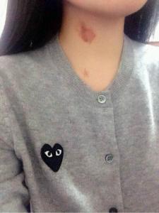 13岁女儿脖子出现