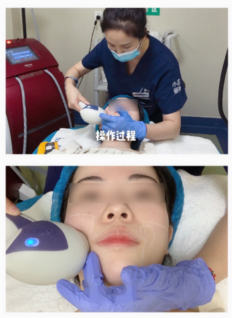 做完小支架提升,想改善眼部皱纹,细纹可以做哪些光电类的项目?