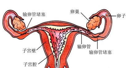 输卵管堵塞只能做试管了吗？