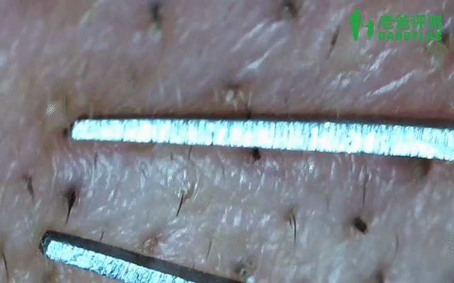 黑头究竟要怎么去？我们拔出并放大了四种类型的黑头