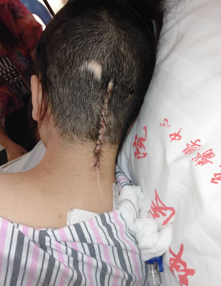 18岁重庆脑瘤女孩圆梦高考，今天将进行第四次开颅手术