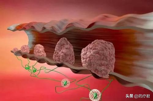 出现黏液便是怎么回事，真的是肠癌的“信号”吗？听听医生怎么说