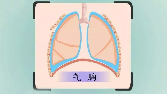 您的肺还好么?查个肺功能一看便知