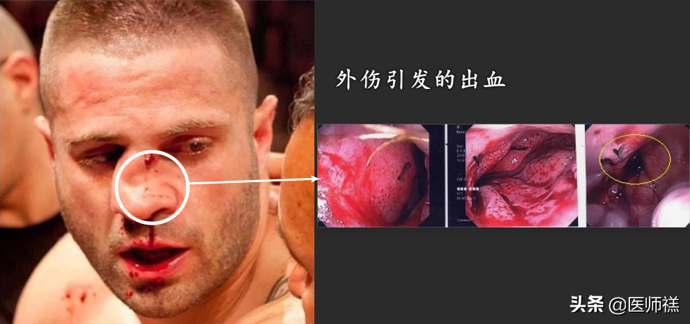 无缘无故流鼻血？以下一些健康问题，医生希望你一定要明白