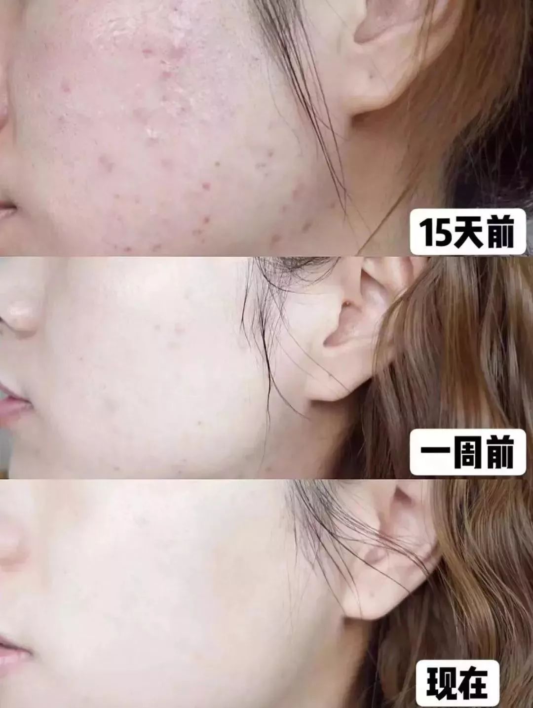 脸上泛红发痒、出油长痘？“螨虫脸”真的很丑，除螨刻不容缓