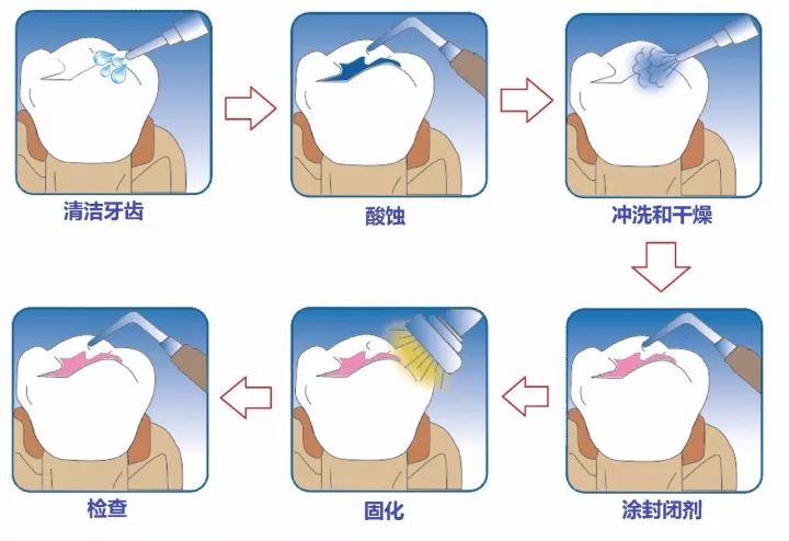 两种公认最有效的儿童防龋方法——涂氟和窝沟封闭，家长建议收藏