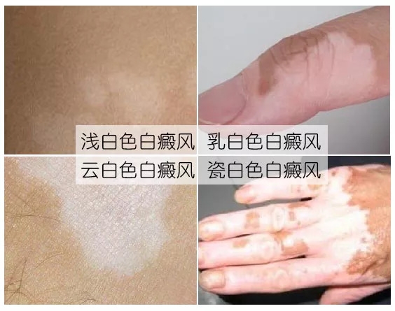 终于找到起白斑的元凶了！医生提醒：6个发病原因，这几个可预防