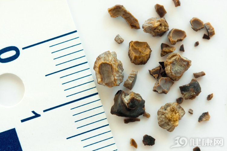 肾结石如何治疗才好？医生：2步分析病情，找到最佳方法