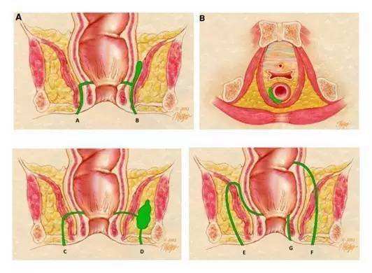 肛门疼痛,流脓,惹上肛瘘怎么办?