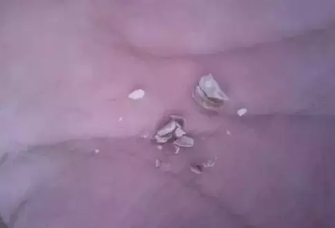 洗牙普通200,深度3000,深度洗牙是忽悠还是真的?