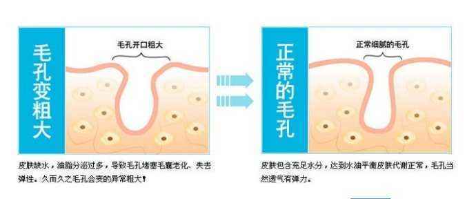 毛孔粗大可以根治吗？收缩毛孔的治疗真相和6个治疗误区要知道